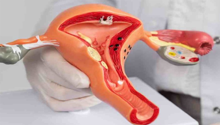 জরায়ুতে ফাইব্রয়েড থাকলে গর্ভপাতের ঝুঁকি বাড়ে, ভিটামিন ডি-এর ঘাটতিও কি এর কারণ?