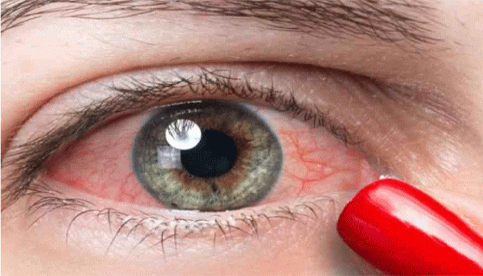 ঘুম থেকে উঠে ফোলা চোখও হতে পারে কিডনির রোগের লক্ষণ! ঘুম থেকে উঠে ফোলা চোখও হতে পারে কিডনির রোগের লক্ষণ!