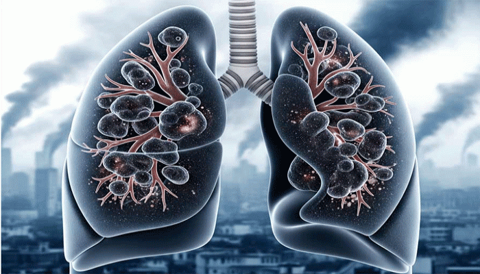 বায়ুদূষণ বদলে দিচ্ছে জিনের গঠন! বাড়ছে ফুসফুসের ক্যানসারের ঝুঁকি বায়ুদূষণ বদলে দিচ্ছে জিনের গঠন! বাড়ছে ফুসফুসের ক্যানসারের ঝুঁকি