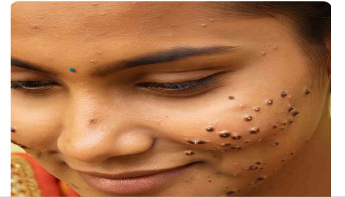 আঁচিলে চুল বা সুতো পেঁচিয়ে রাখা কি ভাল? এতে কী বিপদ হতে পারে?