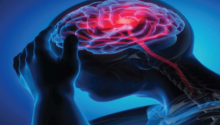 স্ট্রোকের সময়ে প্রাণ বাঁচাতে পারে মাত্র ৬টি অক্ষর! ব্যাখ্যা করলেন চিকিৎসক