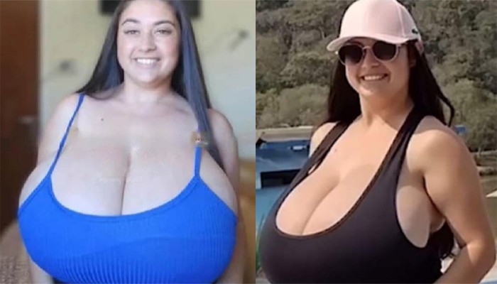 ১২ কেজির বিশাল স্তন! অস্ত্রোপচারে মুক্তি পেলো তরুণী ১২ কেজির বিশাল স্তন! অস্ত্রোপচারে মুক্তি পেলো তরুণী