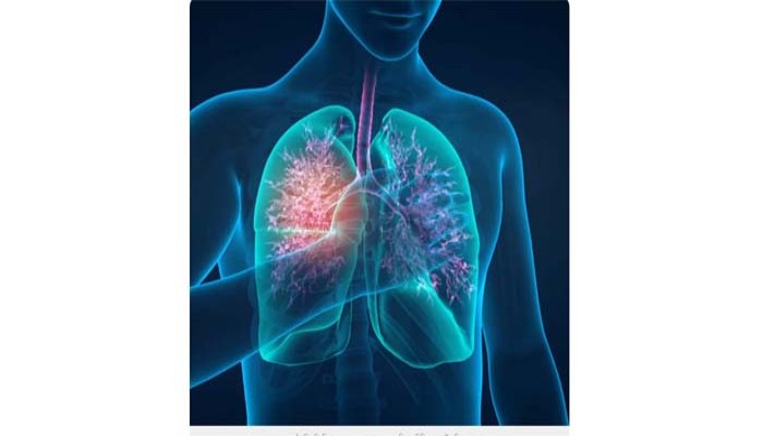 ওষুধ ছাড়াই হাঁপানির চিকিৎসা! ব্রঙ্কিয়াল থার্মোপ্লাস্টি করালে ইনহেলারের প্রয়োজনই ফুরিয়ে যেতে পারে ওষুধ ছাড়াই হাঁপানির চিকিৎসা! ব্রঙ্কিয়াল থার্মোপ্লাস্টি করালে ইনহেলারের প্রয়োজনই ফুরিয়ে যেতে পারে