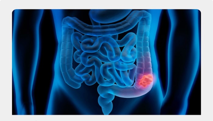 উপসর্গ দেখা দেওয়ার আগেই কোলন ক্যানসার শনাক্ত করা সম্ভব! কী ভাবে সতর্ক হবেন মারণরোগ নিয়ে