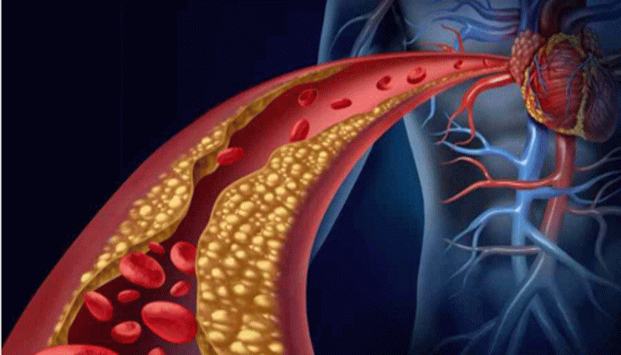 শীতের মরসুমে অনিয়মের কারণে বাড়তে পারে কোলেস্টেরল!
