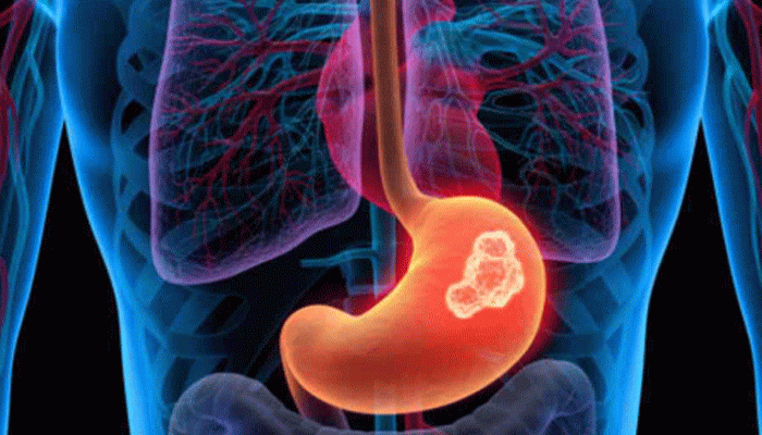 যে ৫ ধরনের খাবার খেলে পেটের ক্যানসারের ঝুঁকি কমবে