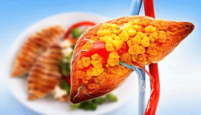 'ফ্যাটি লিভার'-এর সমস্যাকে দূরে রাখতে ডায়েটে বদল জরুরি