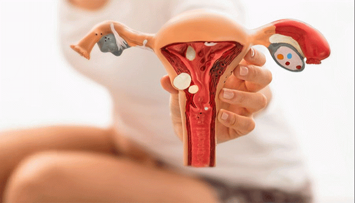 এন্ডোমেট্রিয়োসিস যন্ত্রণার! এড়াতে হলে মহিলাদের বদলাতে হবে ৩ অভ্যাস