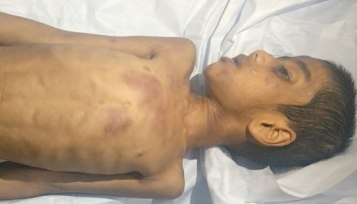 সৎ মায়ের নির্যাতনে মৃত্যুর সন্দেহ, শারীরিক ও বুদ্ধি প্রতিবন্ধীর মরদেহ উদ্ধার