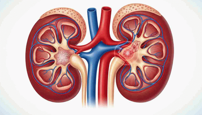 পাঁচ বছর আগেই কিডনির রোগ ধরা পড়বে একটিমাত্র পরীক্ষায়