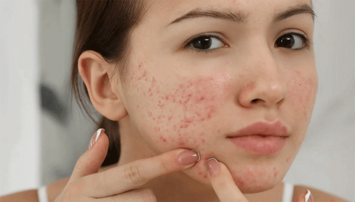 ঘরোয়া পন্থায় লাঘব হবে ব্রণ