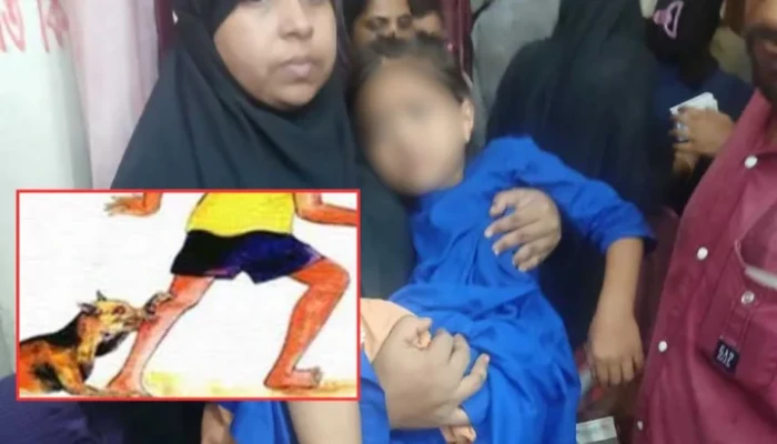 পাগলা কুকুরের কামড়ে পটুয়াখালীতে শিশুসহ আহত ১০