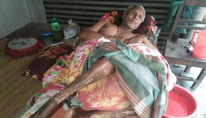 ​ কেমন আছেন ফুলবাড়ী কয়লাখনি বিরোধী আন্দোলনে গুলিবিদ্ধ হয়ে পঙ্গুত্ববরণকারী বাবলু রায়?